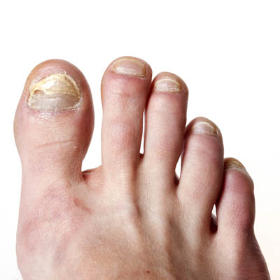 toenail fungus