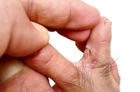 Taking Care of Your Athlete’s Foot