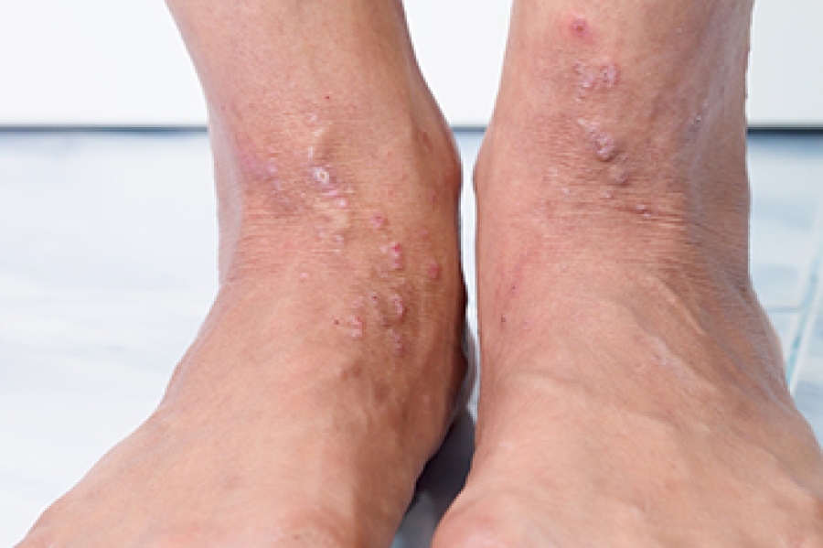 BuschkeOllendorff Syndrome