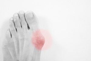 Causes and Finding Relief for Bunions